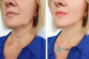 Double chin before and after Hi-Fu treatment 4 Book your double chin treatment Horsham today! We are here to help!