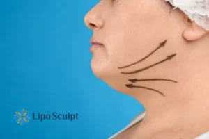 Double chin before and after Hi-Fu treatment 3 Boost your confidence with a Double chin treatment Horsham
