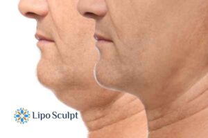 Double chin before and after Hi-Fu treatment 2 Double chin treatment Horsham from Lipo Sculpt - feel more confident today!