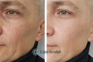 How to Fight Aging Symptoms 3 Fight Aging Symptoms Horsham With HIFU and Morpheus8 Today!