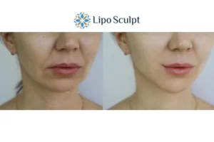 Explaining Total Skin Tightening Treatment And What It Can Do For You 2 Do you want to boost your self confidence? Give Morpheus8 Horsham a try today!