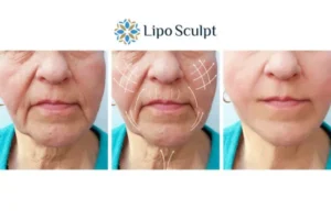 Explaining Total Skin Tightening Treatment And What It Can Do For You 3 Boost your confidence with Morpheus8 Horsham call our team today!