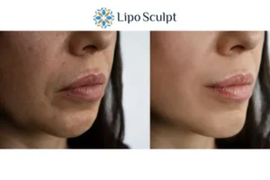 Explaining Total Skin Tightening Treatment And What It Can Do For You 4 Morpheus8 Horsham the best results - call our team today!