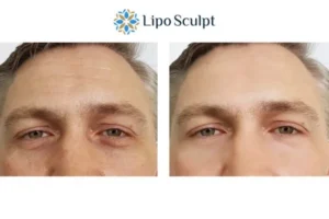 Explaining Total Skin Tightening Treatment And What It Can Do For You 6 Morpheus8 Horsham book in today to find out more!