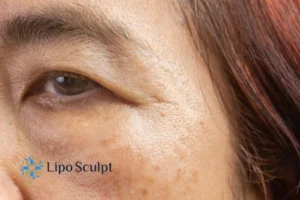 Cryopen: The Revolutionary Treatment for Age Spots Unveiled 2 Are age spots Horsham giving you low self esteem? Contact us today!