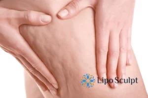 CoolSculpting for Legs: The Innovative Approach to Redefining Your Legs 5 Start your journey today book your coolsculpting treatment Horsham online today!