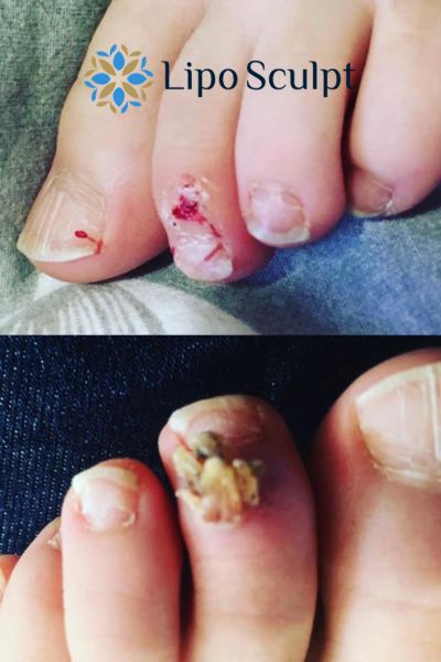 Wart removal customer results from Lipo Sculpt Horsham