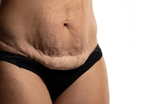 Lost the Weight but Not the Loose Skin? 1 image of womans stomach after weight loss showing loose skin Horsham
